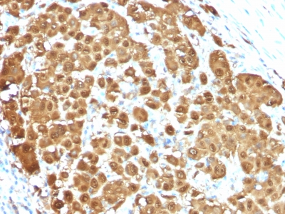 FFPE human melanoma sections stained with 100 ul anti-S100B (clone S100B/1012) at 1:50. HIER epitope retrieval prior to staining was performed in 10mM Citrate, pH 6.0.